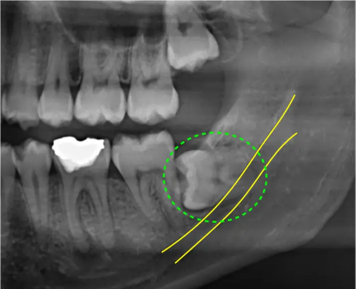 難抜歯症例：神経が近い横向きの親知らずの抜歯